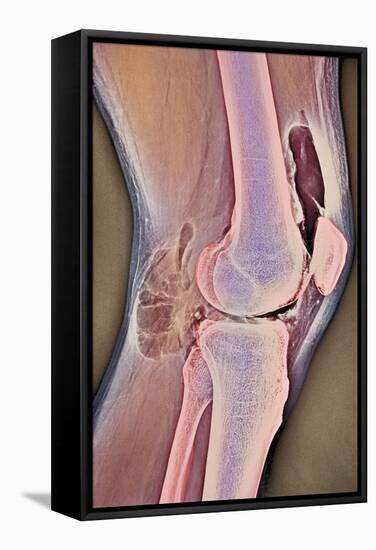 Osteoarthritic Knee X-ray-null-Framed Premier Image Canvas