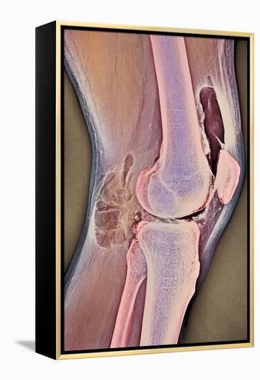 Osteoarthritic Knee X-ray-null-Framed Premier Image Canvas