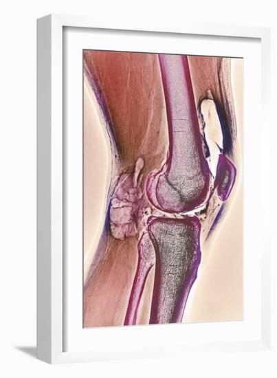 Osteoarthritic Knee X-ray-null-Framed Photographic Print