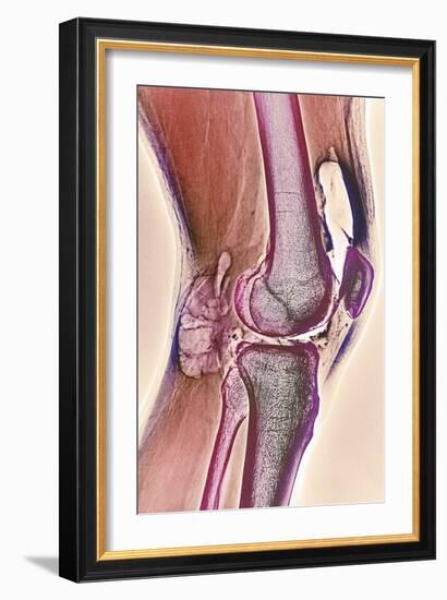 Osteoarthritic Knee X-ray-null-Framed Photographic Print