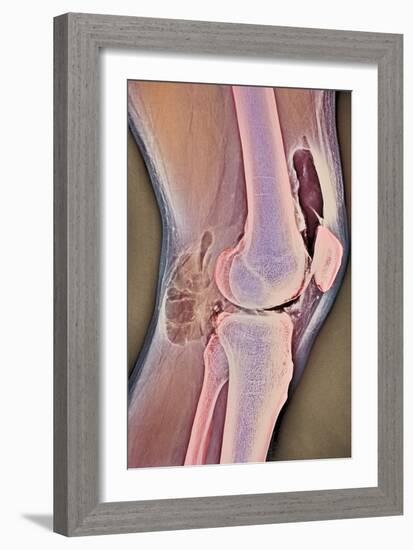 Osteoarthritic Knee X-ray-null-Framed Photographic Print