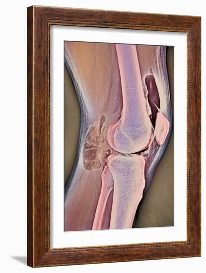 Osteoarthritic Knee X-ray-null-Framed Photographic Print