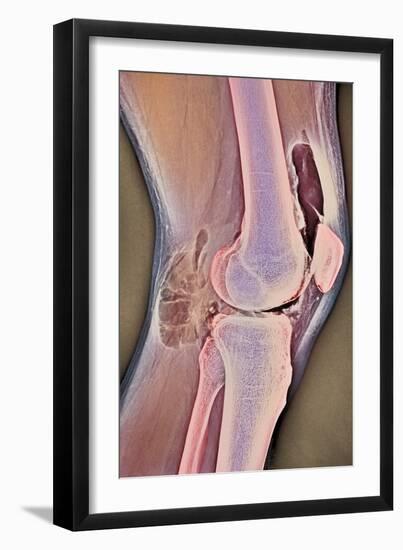 Osteoarthritic Knee X-ray-null-Framed Photographic Print