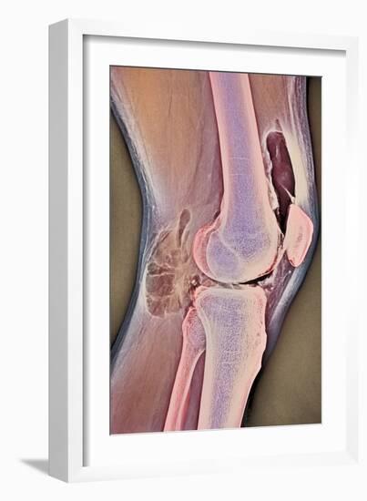 Osteoarthritic Knee X-ray-null-Framed Photographic Print