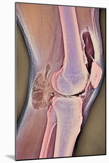 Osteoarthritic Knee X-ray-null-Mounted Photographic Print