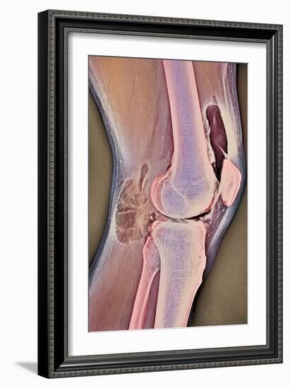 Osteoarthritic Knee X-ray-null-Framed Photographic Print