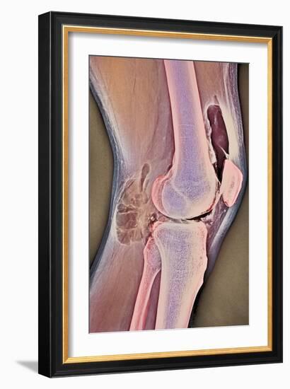 Osteoarthritic Knee X-ray-null-Framed Photographic Print