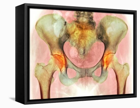 Osteoarthritis of Hip Joints, X-ray-Science Photo Library-Framed Premier Image Canvas