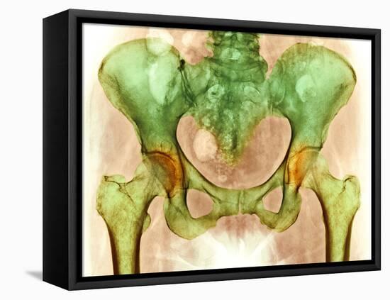 Osteoarthritis of Hip Joints, X-ray-Science Photo Library-Framed Premier Image Canvas