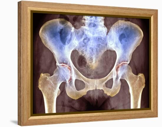 Osteoarthritis of Hip Joints, X-ray-Science Photo Library-Framed Premier Image Canvas