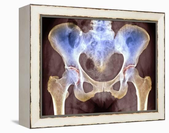 Osteoarthritis of Hip Joints, X-ray-Science Photo Library-Framed Premier Image Canvas