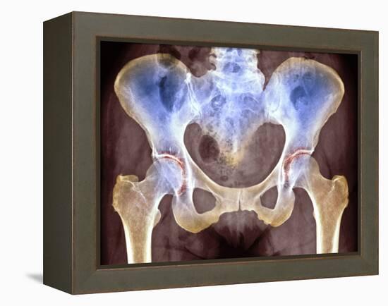 Osteoarthritis of Hip Joints, X-ray-Science Photo Library-Framed Premier Image Canvas