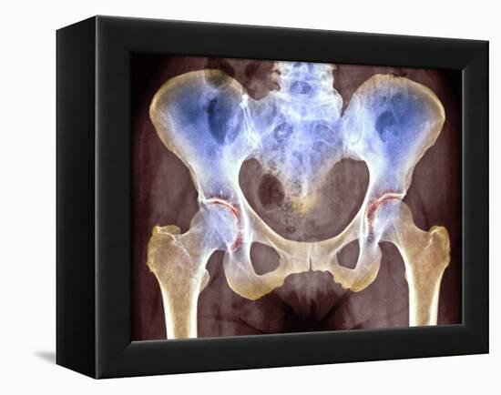 Osteoarthritis of Hip Joints, X-ray-Science Photo Library-Framed Premier Image Canvas