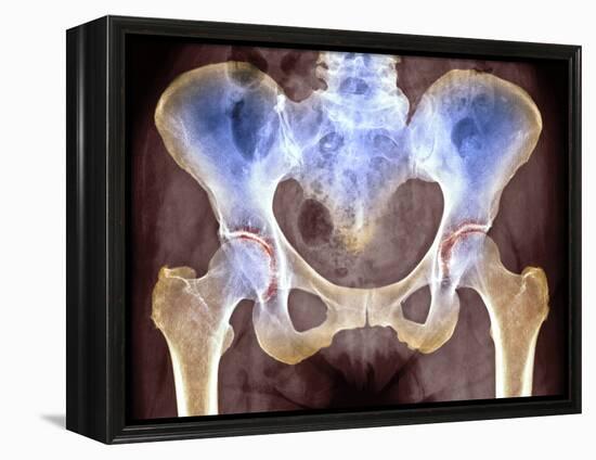 Osteoarthritis of Hip Joints, X-ray-Science Photo Library-Framed Premier Image Canvas