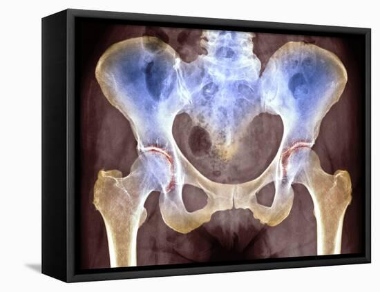 Osteoarthritis of Hip Joints, X-ray-Science Photo Library-Framed Premier Image Canvas