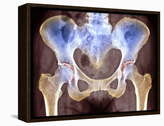 Osteoarthritis of Hip Joints, X-ray-Science Photo Library-Framed Premier Image Canvas