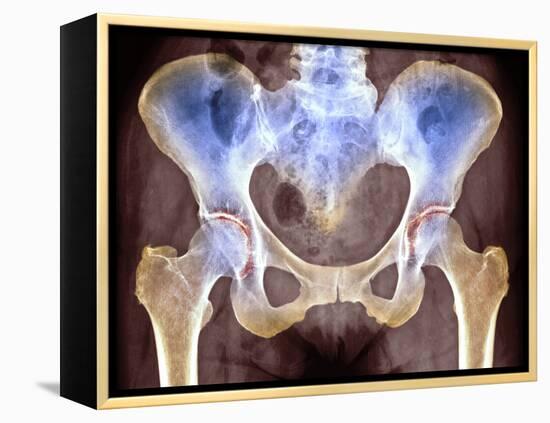 Osteoarthritis of Hip Joints, X-ray-Science Photo Library-Framed Premier Image Canvas