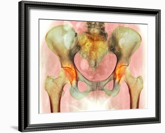 Osteoarthritis of Hip Joints, X-ray-Science Photo Library-Framed Photographic Print