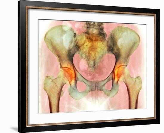 Osteoarthritis of Hip Joints, X-ray-Science Photo Library-Framed Photographic Print