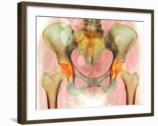 Osteoarthritis of Hip Joints, X-ray-Science Photo Library-Framed Photographic Print