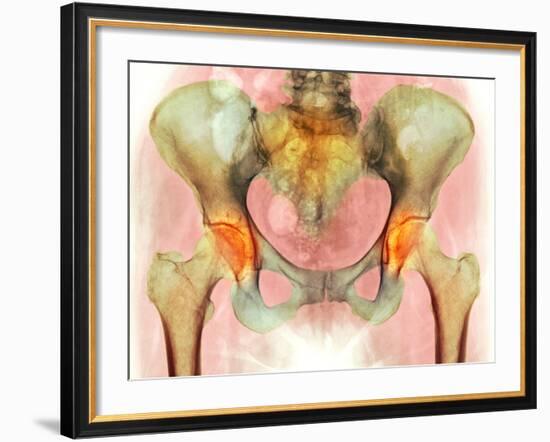 Osteoarthritis of Hip Joints, X-ray-Science Photo Library-Framed Photographic Print