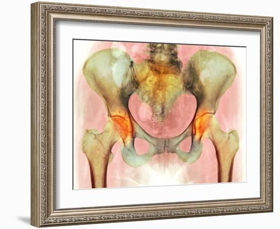 Osteoarthritis of Hip Joints, X-ray-Science Photo Library-Framed Photographic Print