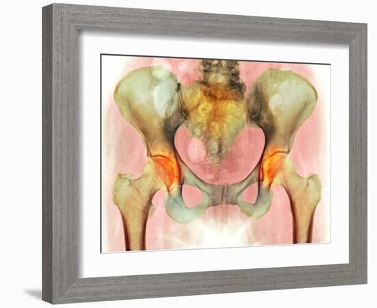 Osteoarthritis of Hip Joints, X-ray-Science Photo Library-Framed Photographic Print