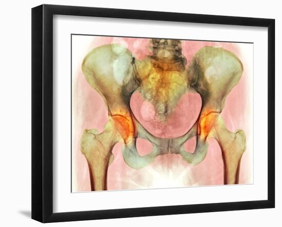 Osteoarthritis of Hip Joints, X-ray-Science Photo Library-Framed Photographic Print