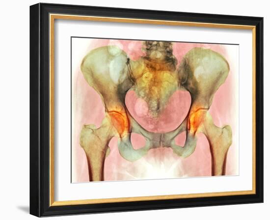 Osteoarthritis of Hip Joints, X-ray-Science Photo Library-Framed Photographic Print