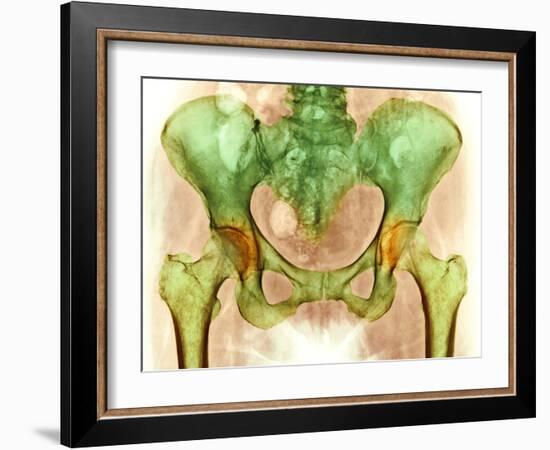 Osteoarthritis of Hip Joints, X-ray-Science Photo Library-Framed Photographic Print