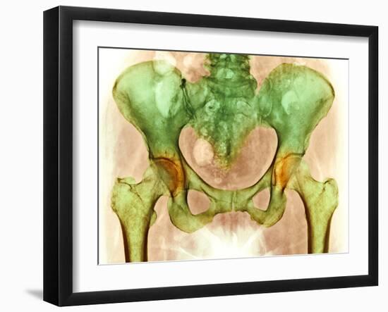 Osteoarthritis of Hip Joints, X-ray-Science Photo Library-Framed Photographic Print