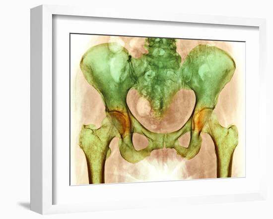 Osteoarthritis of Hip Joints, X-ray-Science Photo Library-Framed Photographic Print