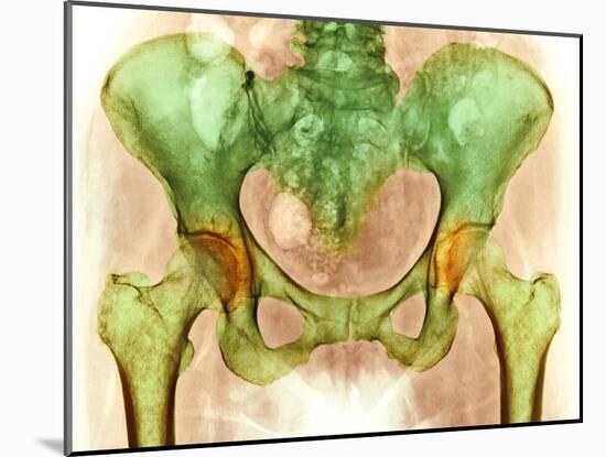 Osteoarthritis of Hip Joints, X-ray-Science Photo Library-Mounted Photographic Print