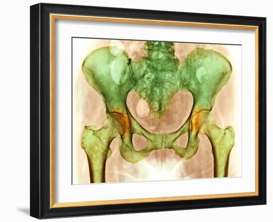 Osteoarthritis of Hip Joints, X-ray-Science Photo Library-Framed Photographic Print