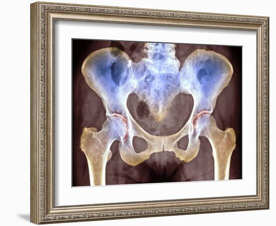 Osteoarthritis of Hip Joints, X-ray-Science Photo Library-Framed Photographic Print