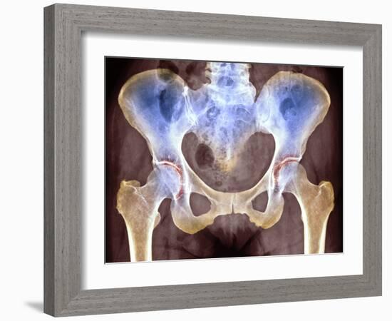 Osteoarthritis of Hip Joints, X-ray-Science Photo Library-Framed Photographic Print