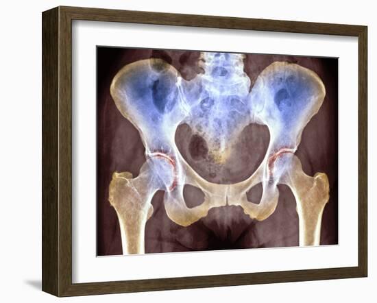 Osteoarthritis of Hip Joints, X-ray-Science Photo Library-Framed Photographic Print