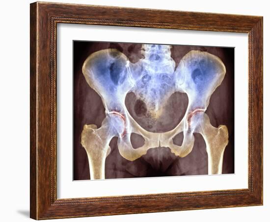 Osteoarthritis of Hip Joints, X-ray-Science Photo Library-Framed Photographic Print