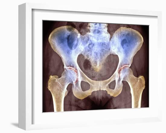 Osteoarthritis of Hip Joints, X-ray-Science Photo Library-Framed Photographic Print