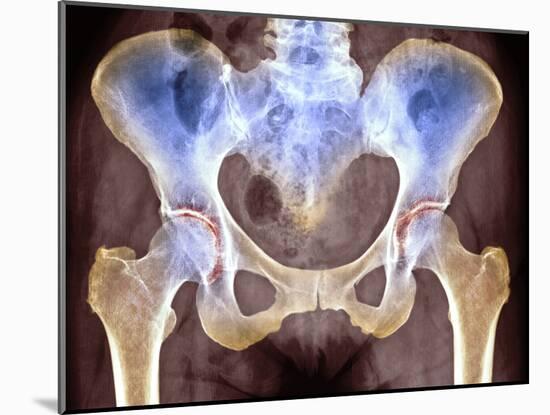 Osteoarthritis of Hip Joints, X-ray-Science Photo Library-Mounted Photographic Print