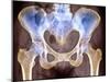 Osteoarthritis of Hip Joints, X-ray-Science Photo Library-Mounted Photographic Print