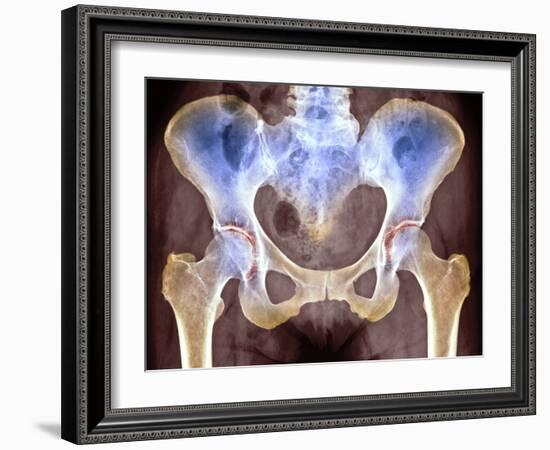 Osteoarthritis of Hip Joints, X-ray-Science Photo Library-Framed Photographic Print