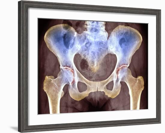 Osteoarthritis of Hip Joints, X-ray-Science Photo Library-Framed Photographic Print