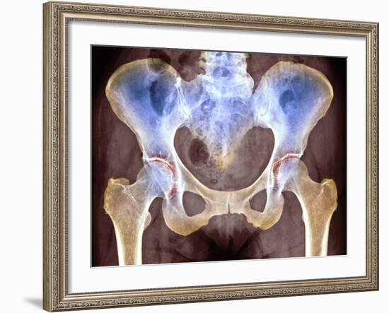 Osteoarthritis of Hip Joints, X-ray-Science Photo Library-Framed Photographic Print