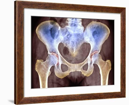 Osteoarthritis of Hip Joints, X-ray-Science Photo Library-Framed Photographic Print