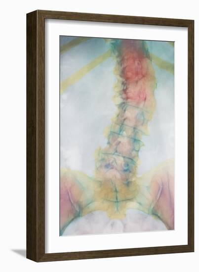 Osteoporosis of Spine, X-ray-Science Photo Library-Framed Photographic Print