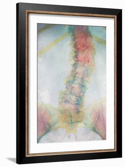 Osteoporosis of Spine, X-ray-Science Photo Library-Framed Photographic Print