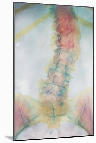 Osteoporosis of Spine, X-ray-Science Photo Library-Mounted Photographic Print