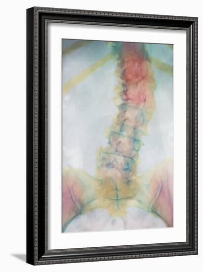 Osteoporosis of Spine, X-ray-Science Photo Library-Framed Photographic Print