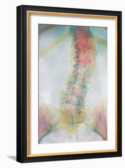 Osteoporosis of Spine, X-ray-Science Photo Library-Framed Photographic Print